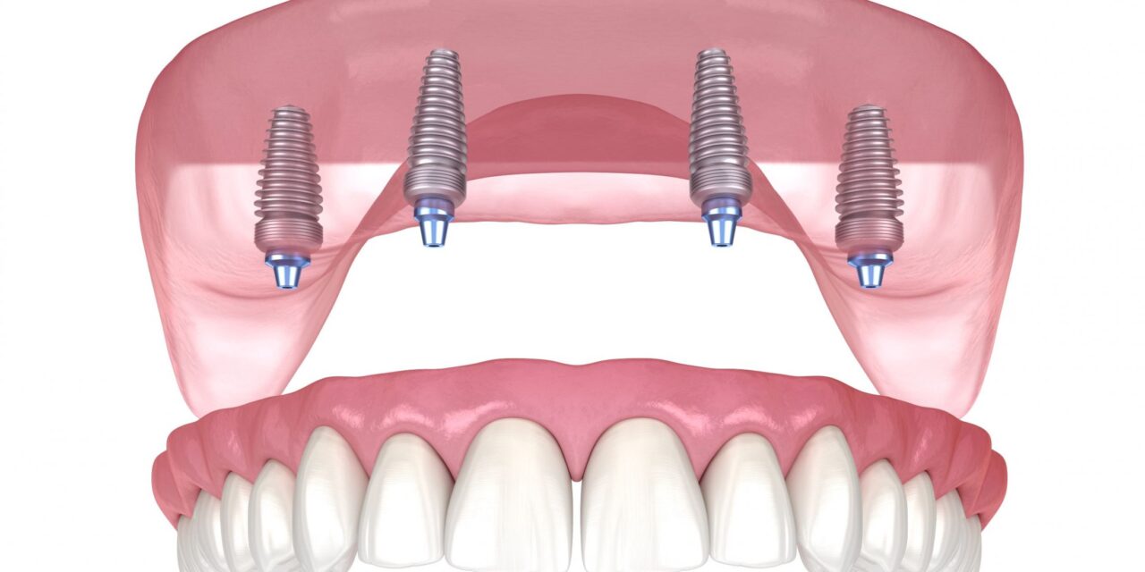 All on FOUR Dental Implants